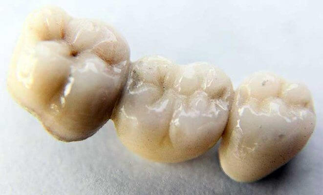 Se Uno Ingoia Un Ponte Dentale