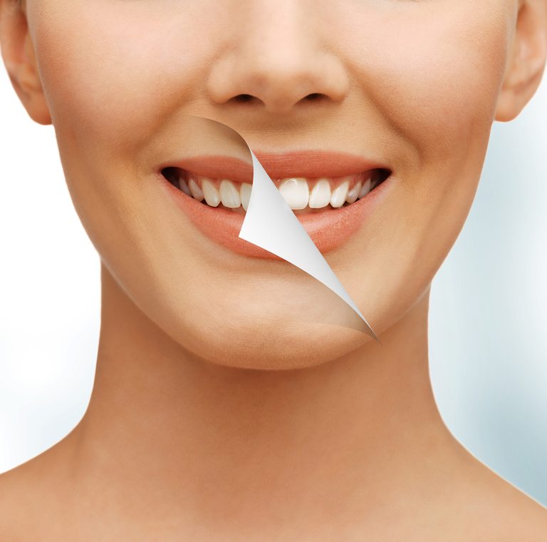 Apparecchio invisibile o Invisalign: opinioni degli utenti