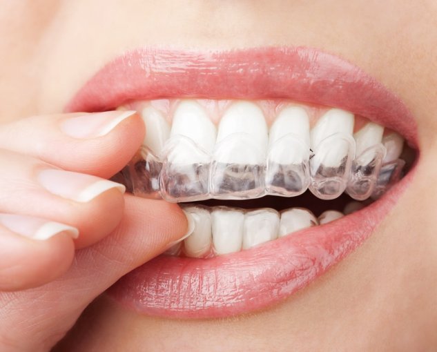 Strumento Per Rimuovere Allineatori Ortodontici E Brackets – Gancio Bianco Professionale