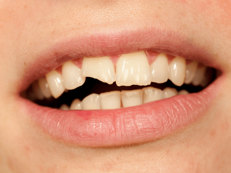 Estrazione dente quando è necessaria e cosa fare dopo Estrazione dente quando è necessaria e cosa fare dopo
