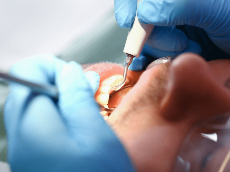 Come Togliere Il Tartaro Dai Denti Prevenzione E Trattamenti come-togliere-il-tartaro-dai-denti-prevenzione-e-trattamenti