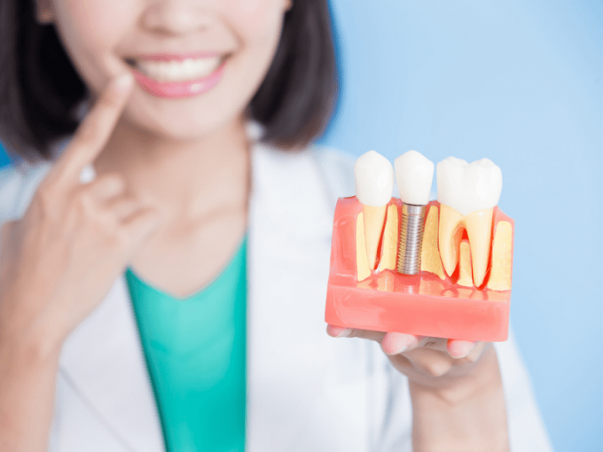 Differenze Tra Perno Dentale E Impianto Dentale - Foto 2