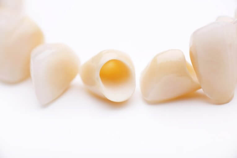 Costo corona dentale resina - Come scegliere quella giusta