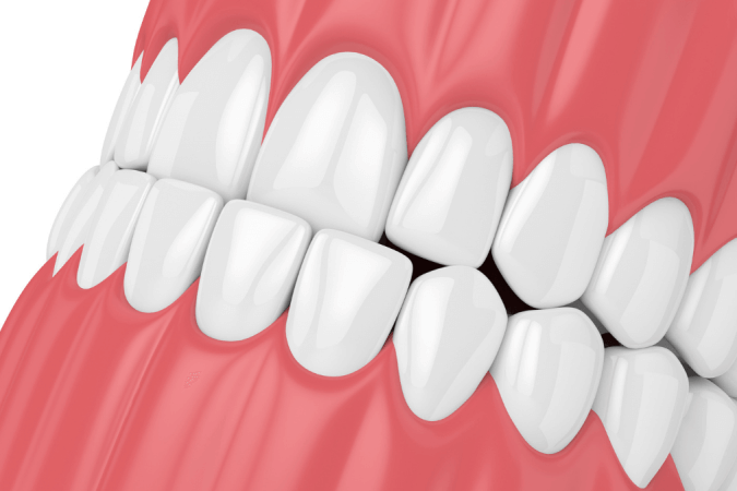 Bite dentale: cos'è, come si utilizza e quanto costa