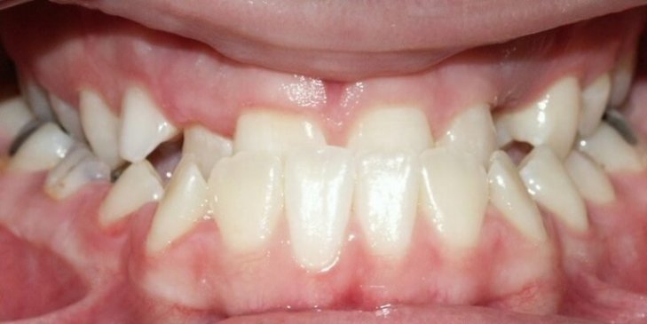 Modello Con Vallo Di Occlusione In Resina | GF Dental - Foto 2